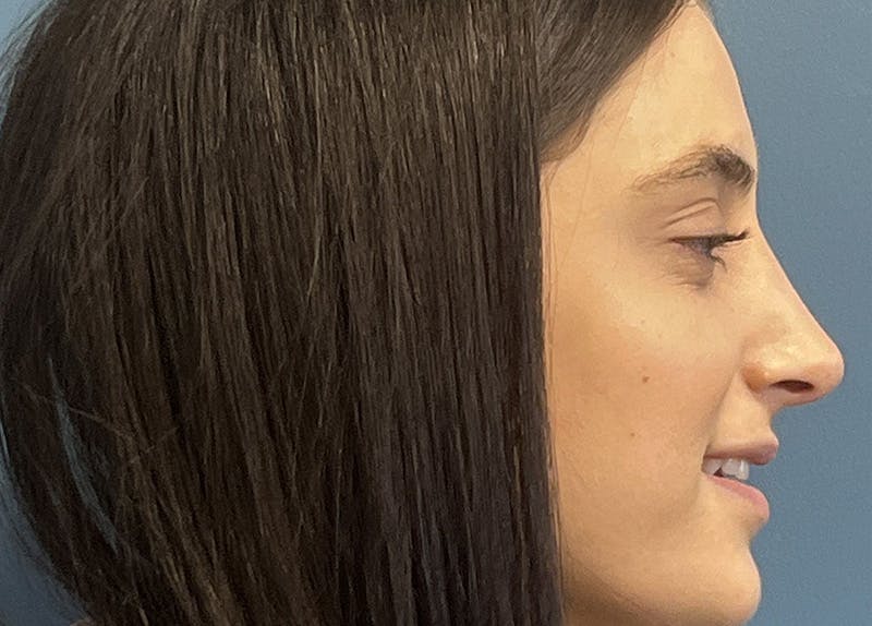 Rhinoplasty Before & After Gallery - Patient 240457 - Image 2