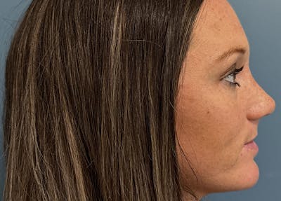 Rhinoplasty Before & After Gallery - Patient 279269 - Image 2