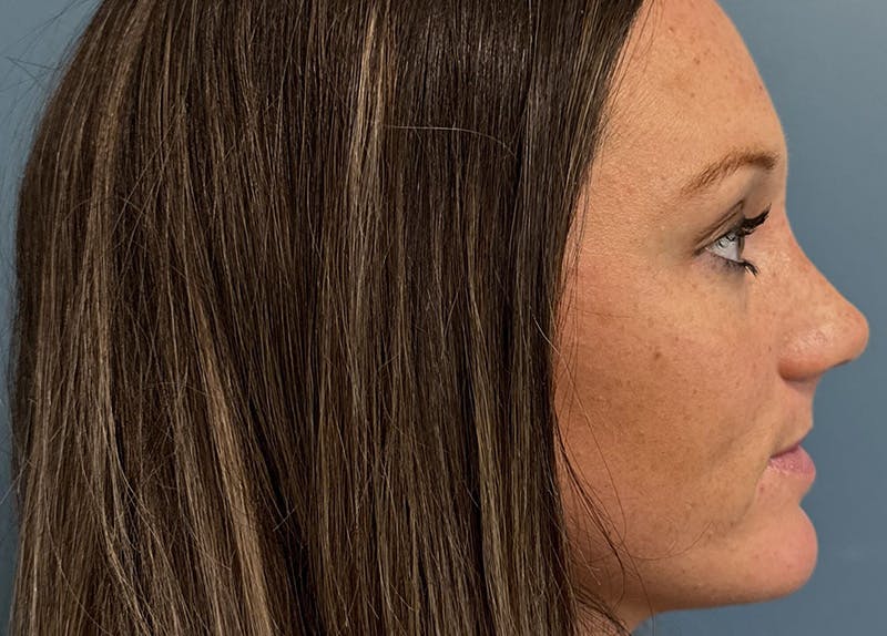 Rhinoplasty Before & After Gallery - Patient 279269 - Image 2