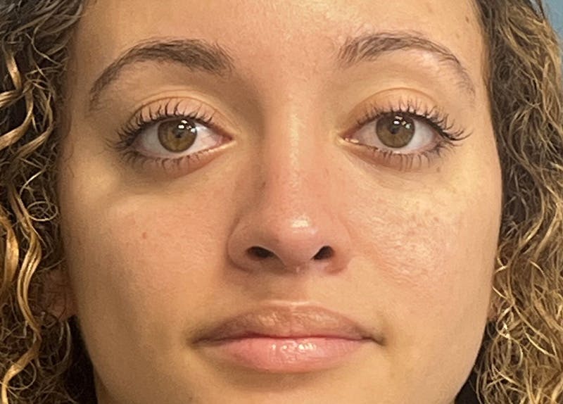 Rhinoplasty Before & After Gallery - Patient 148440 - Image 4
