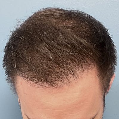 FUE Hair Restoration Before & After Gallery - Patient 375043 - Image 2