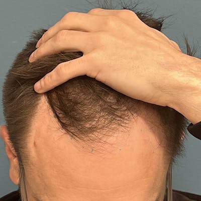 FUE Hair Restoration Before & After Gallery - Patient 375043 - Image 1