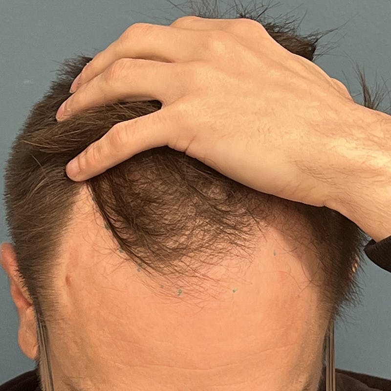 FUE Hair Restoration Before & After Gallery - Patient 375043 - Image 1