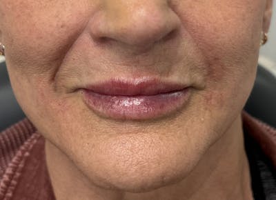 Dermal Fillers & Botox Before & After Gallery - Patient 140505 - Image 2