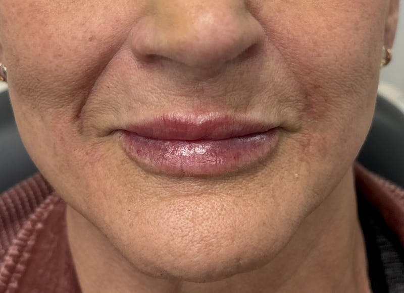 Dermal Fillers & Botox Before & After Gallery - Patient 140505 - Image 2