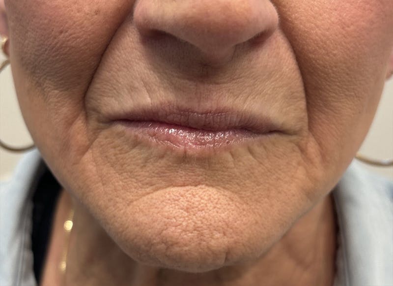 Dermal Fillers & Botox Before & After Gallery - Patient 140505 - Image 1