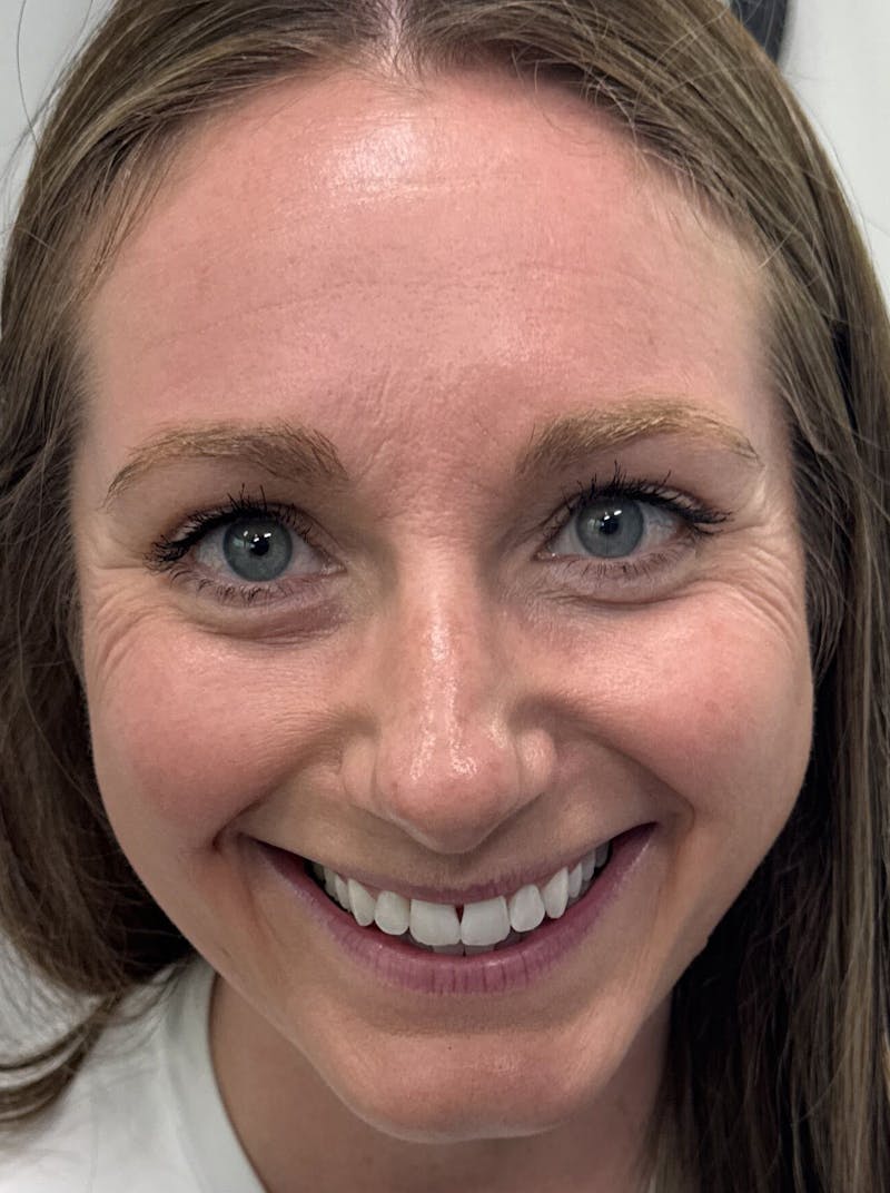 Dermal Fillers & Botox Before & After Gallery - Patient 219242 - Image 1