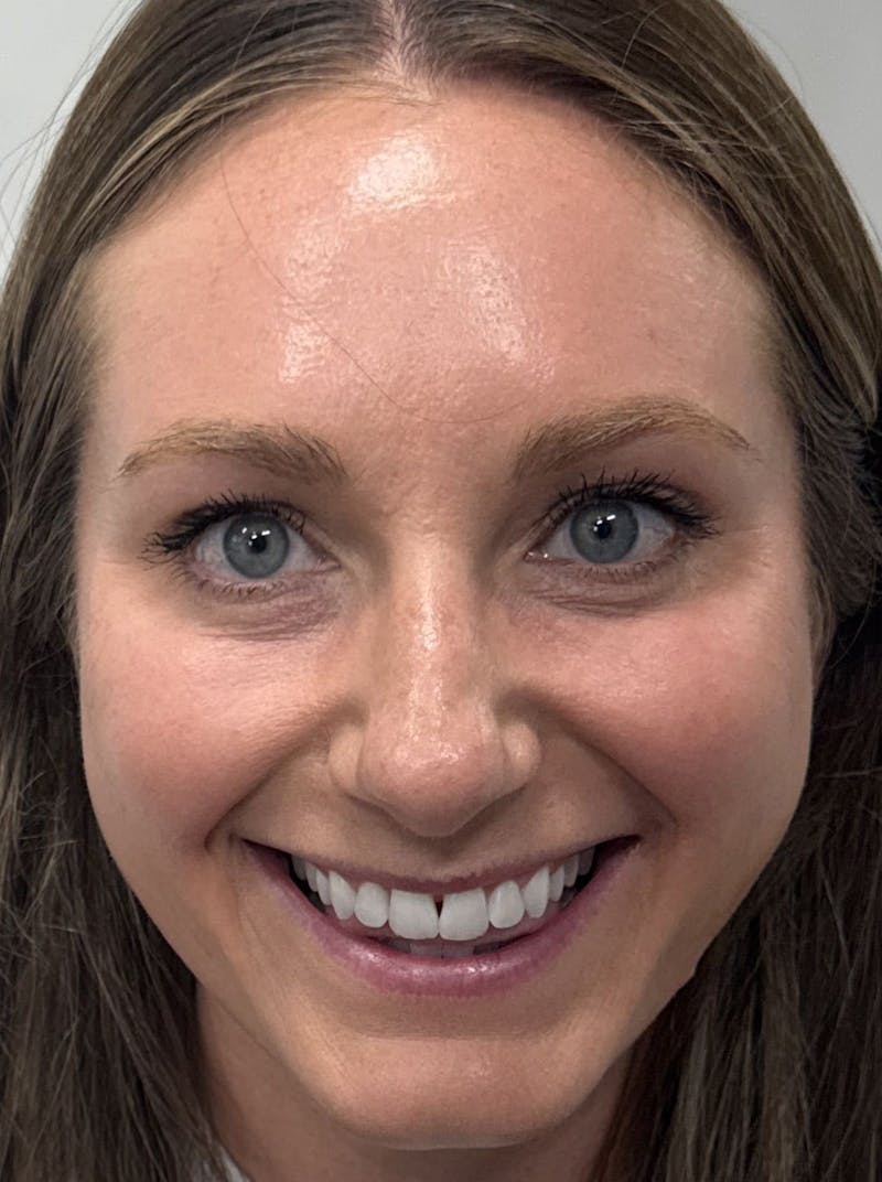 Dermal Fillers & Botox Before & After Gallery - Patient 219242 - Image 2