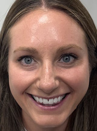 Dermal Fillers & Botox Before & After Gallery - Patient 219242 - Image 2