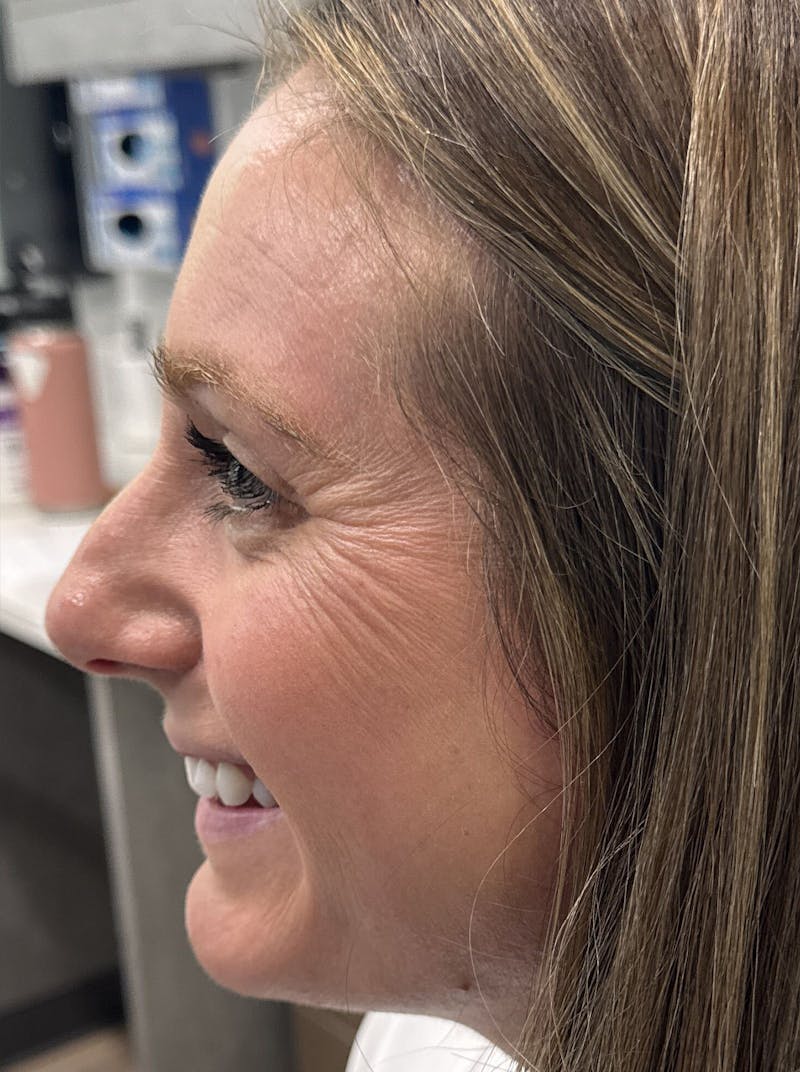 Dermal Fillers & Botox Before & After Gallery - Patient 219242 - Image 3