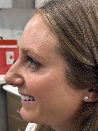 Dermal Fillers & Botox Before & After Gallery - Patient 219242 - Image 4