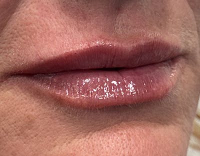 Dermal Fillers & Botox Before & After Gallery - Patient 335195 - Image 2