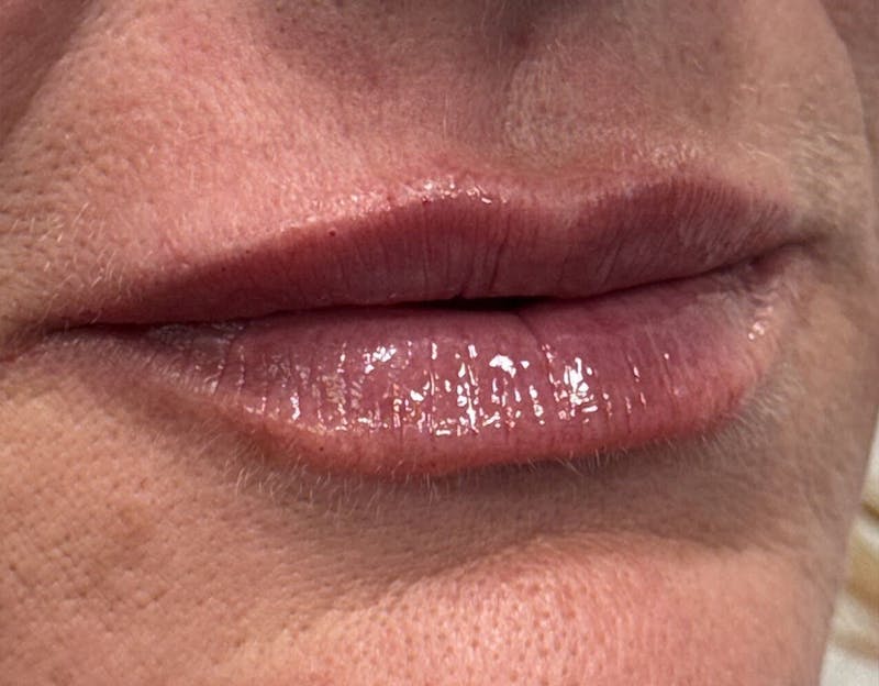 Dermal Fillers & Botox Before & After Gallery - Patient 335195 - Image 2