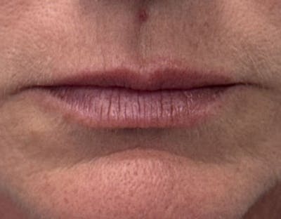 Dermal Fillers & Botox Before & After Gallery - Patient 335195 - Image 1
