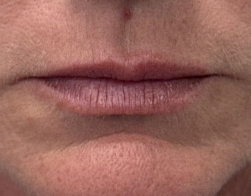 Dermal Fillers & Botox Before & After Gallery - Patient 335195 - Image 1