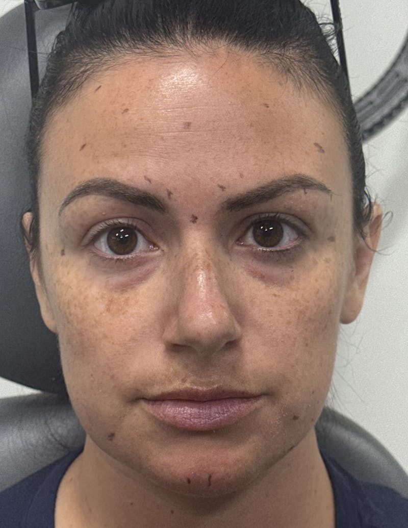 Dermal Fillers & Botox Before & After Gallery - Patient 299197 - Image 2
