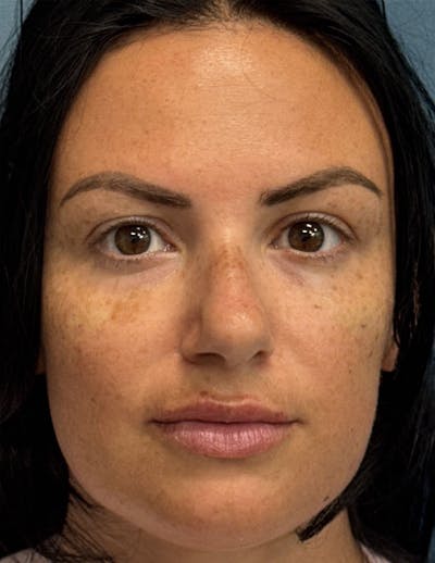 Dermal Fillers & Botox Before & After Gallery - Patient 299197 - Image 1