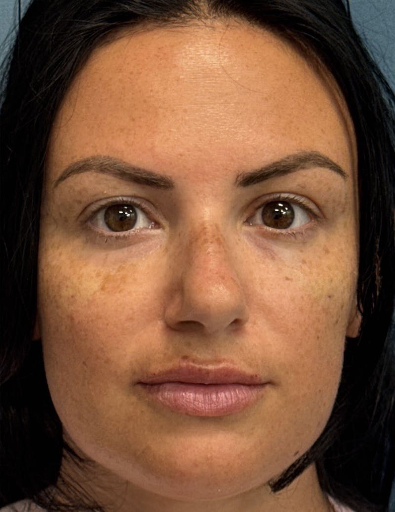 Dermal Fillers & Botox Before & After Gallery - Patient 299197 - Image 1