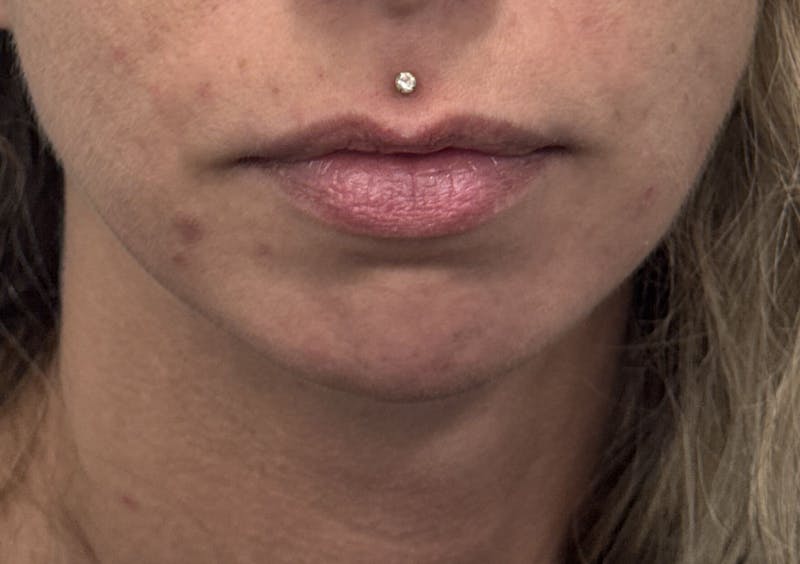 Dermal Fillers & Botox Before & After Gallery - Patient 256248 - Image 1