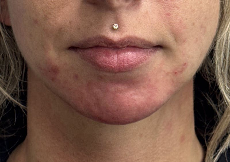 Dermal Fillers & Botox Before & After Gallery - Patient 256248 - Image 2