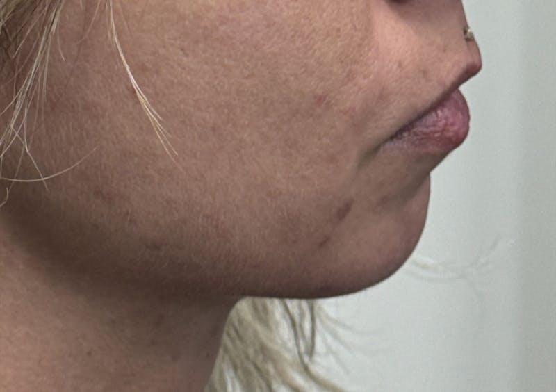 Dermal Fillers & Botox Before & After Gallery - Patient 256248 - Image 3