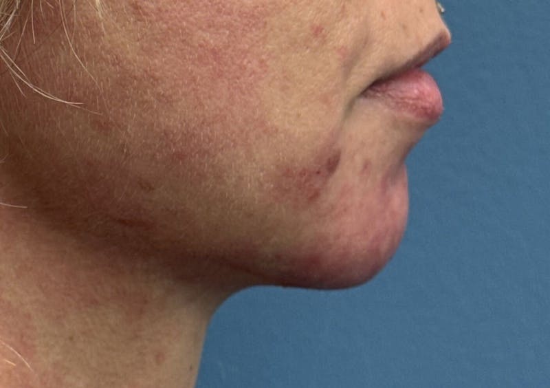 Dermal Fillers & Botox Before & After Gallery - Patient 256248 - Image 4
