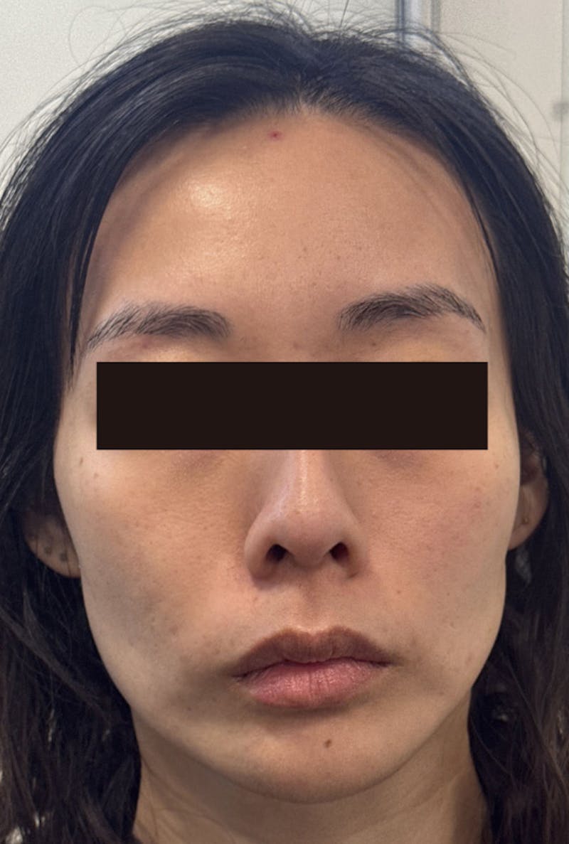 Sculptra for the Face Before & After Gallery - Patient 373502 - Image 1