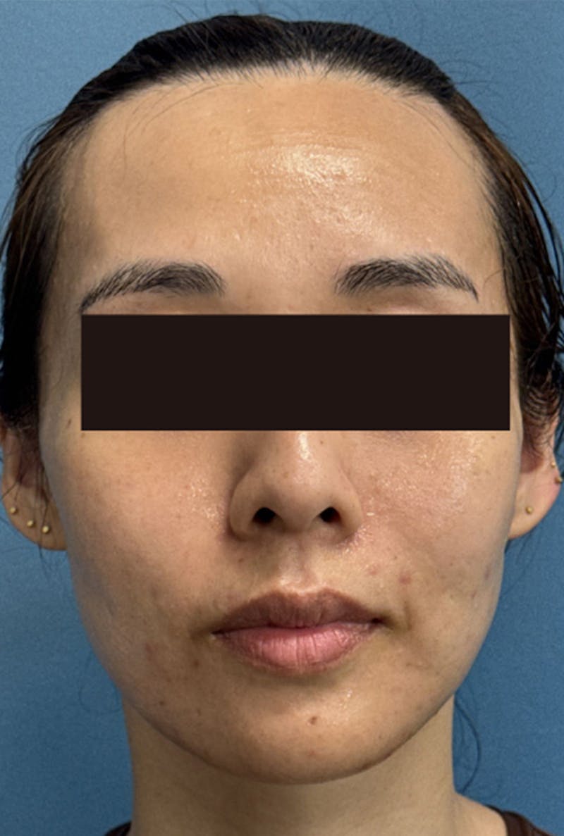 Sculptra for the Face Before & After Gallery - Patient 373502 - Image 2