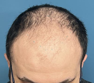FUE Hair Restoration Before & After Gallery - Patient 335672 - Image 1