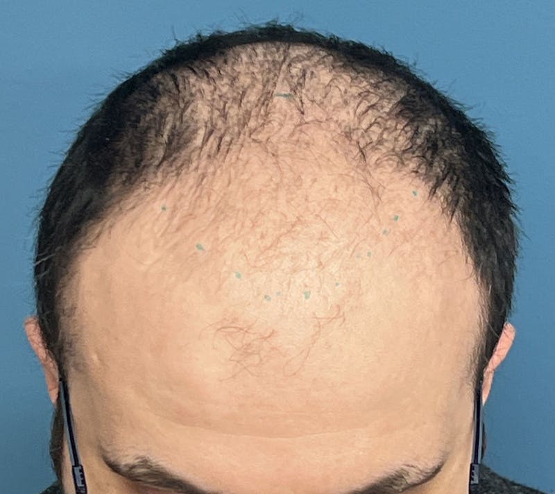 FUE Hair Restoration Before & After Gallery - Patient 335672 - Image 1