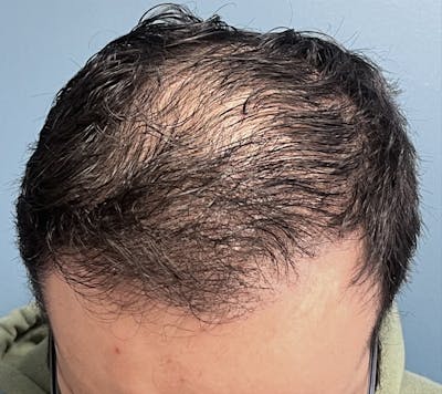 FUE Hair Restoration Before & After Gallery - Patient 335672 - Image 2