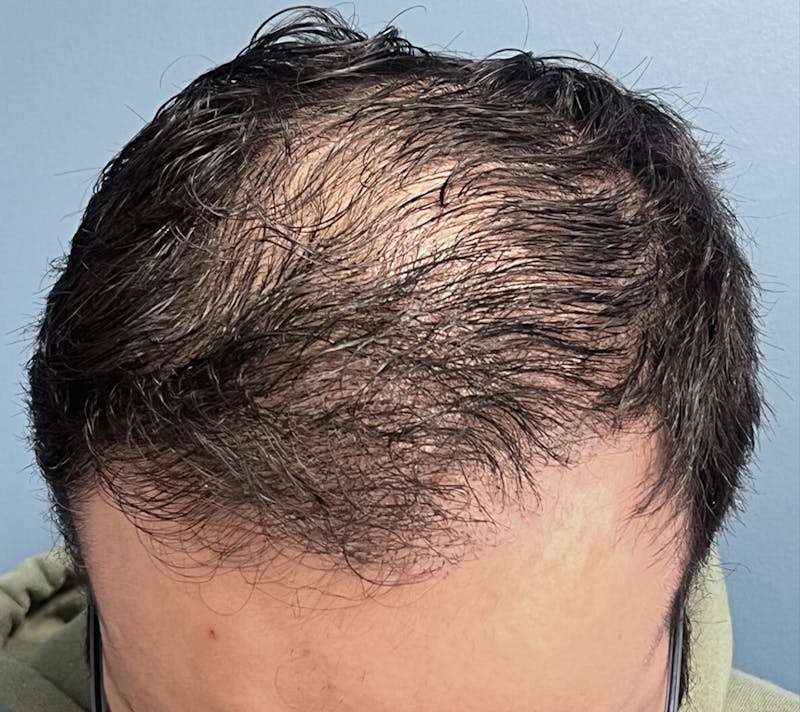 FUE Hair Restoration Before & After Gallery - Patient 335672 - Image 2