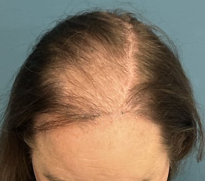 FUE Hair Restoration Before & After Gallery - Patient 165113 - Image 1