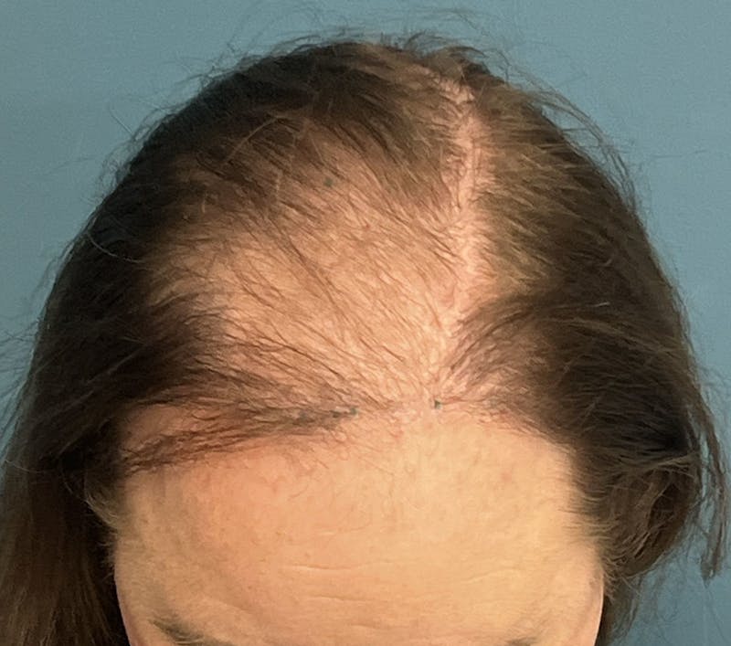 FUE Hair Restoration Before & After Gallery - Patient 165113 - Image 1