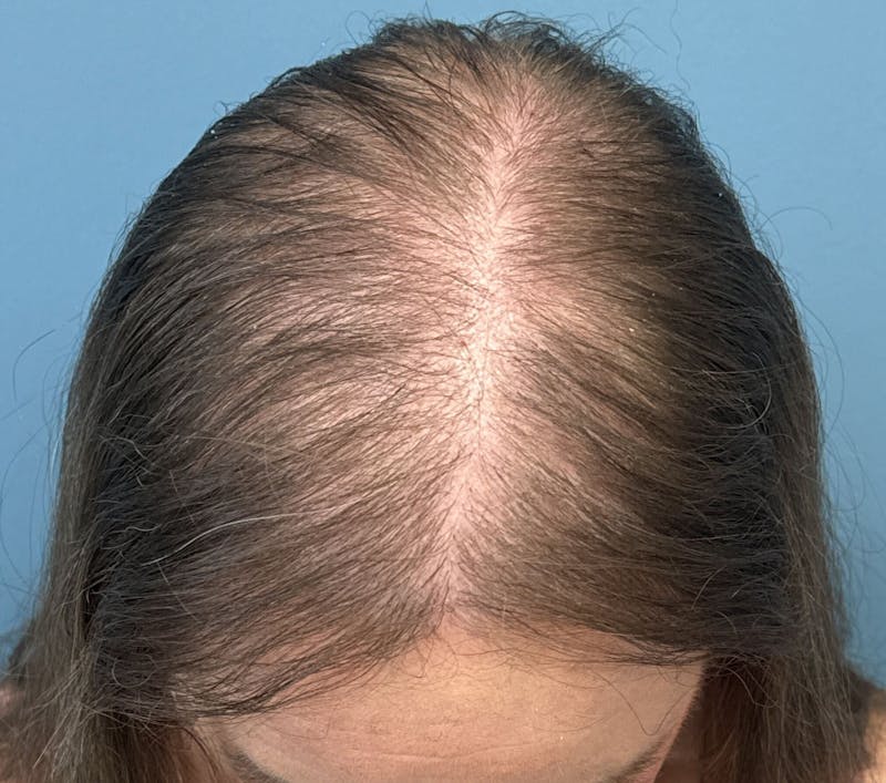FUE Hair Restoration Before & After Gallery - Patient 165113 - Image 2