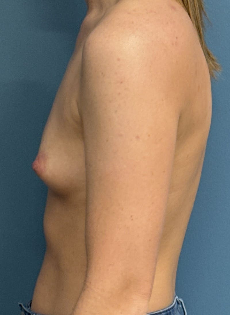 Breast Augmentation Before & After Gallery - Patient 208979 - Image 3