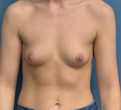 Breast Augmentation Before & After Gallery - Patient 208979 - Image 1