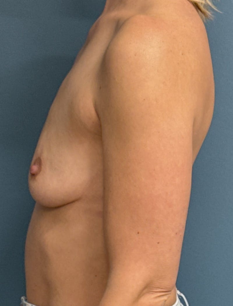 Breast Augmentation Before & After Gallery - Patient 549947 - Image 3