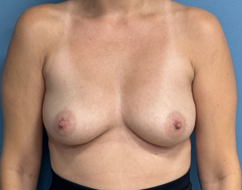 Breast Augmentation Before & After Gallery - Patient 239572 - Image 1