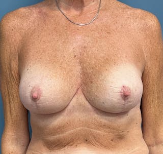 Breast Augmentation with Lift Before & After Gallery - Patient 149928 - Image 2