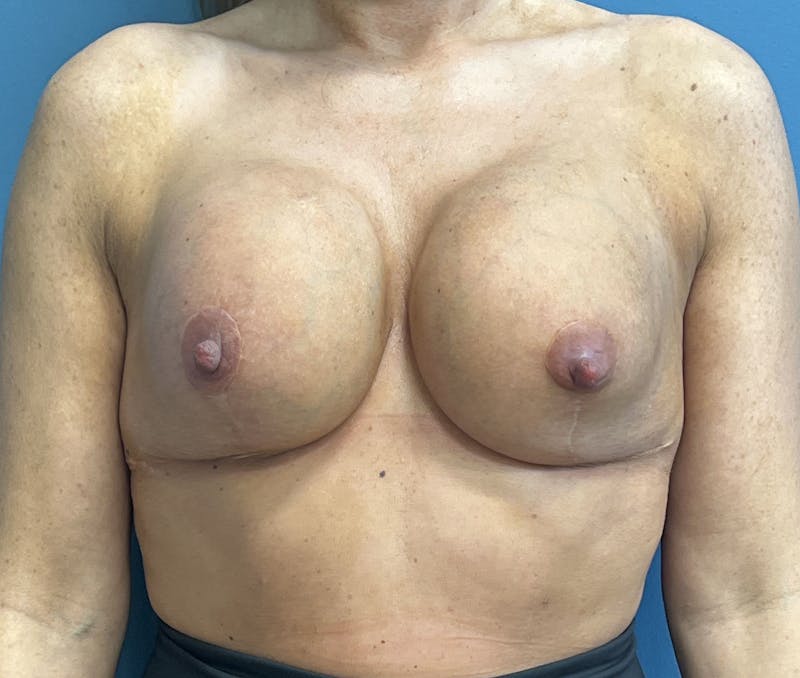 Breast Revision  Before & After Gallery - Patient 178811 - Image 1