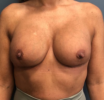 Breast Revision  Before & After Gallery - Patient 178811 - Image 2