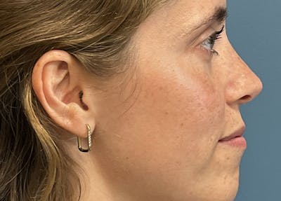 Rhinoplasty Before & After Gallery - Patient 104699 - Image 2