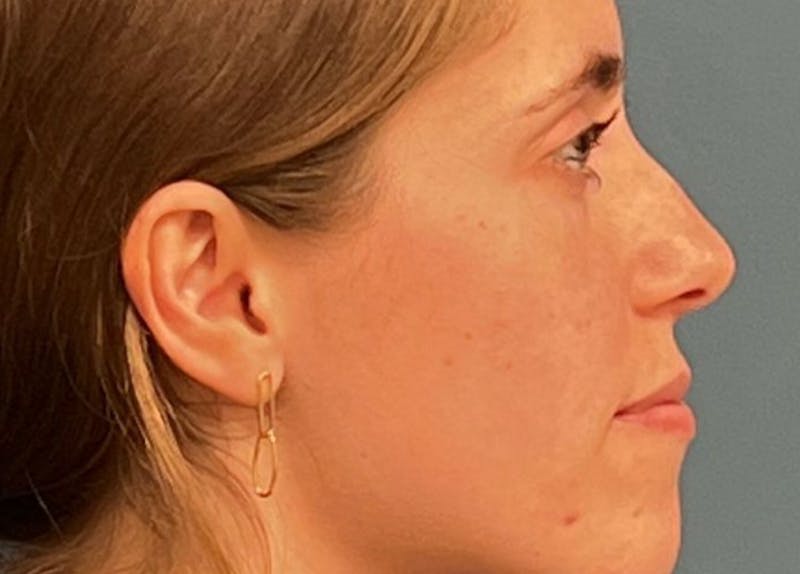 Rhinoplasty Before & After Gallery - Patient 104699 - Image 1