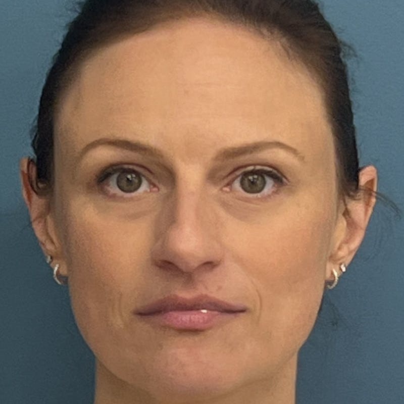 Rhinoplasty Before & After Gallery - Patient 313446 - Image 3