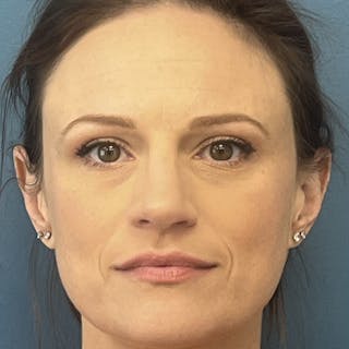 Rhinoplasty Before & After Gallery - Patient 313446 - Image 4