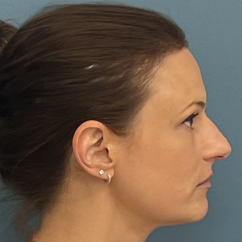 Rhinoplasty Before & After Gallery - Patient 313446 - Image 1