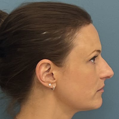 Rhinoplasty Before & After Gallery - Patient 313446 - Image 1