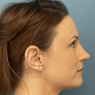 Rhinoplasty Before & After Gallery - Patient 313446 - Image 2
