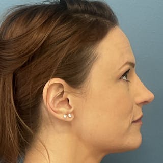 Rhinoplasty Before & After Gallery - Patient 313446 - Image 2